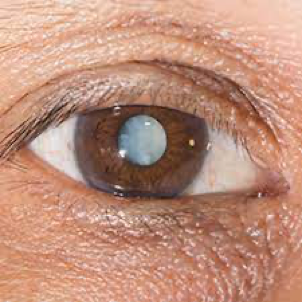 Eye Cataract Anatomy