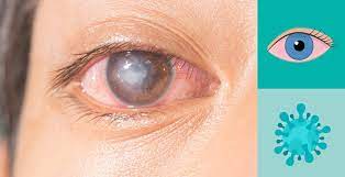 Corneal Ulcer Evaluation