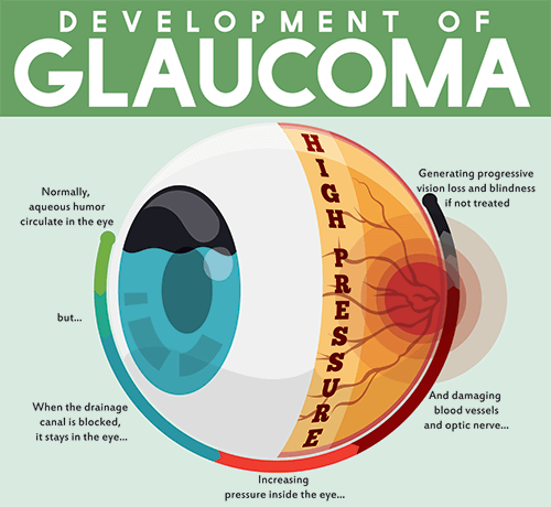 Glaucoma Fluid Pressure Diagram